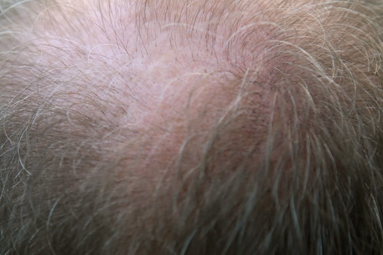Stem Cell Therapy for Hair Loss in 2024