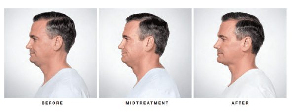 chin fat removal before and after