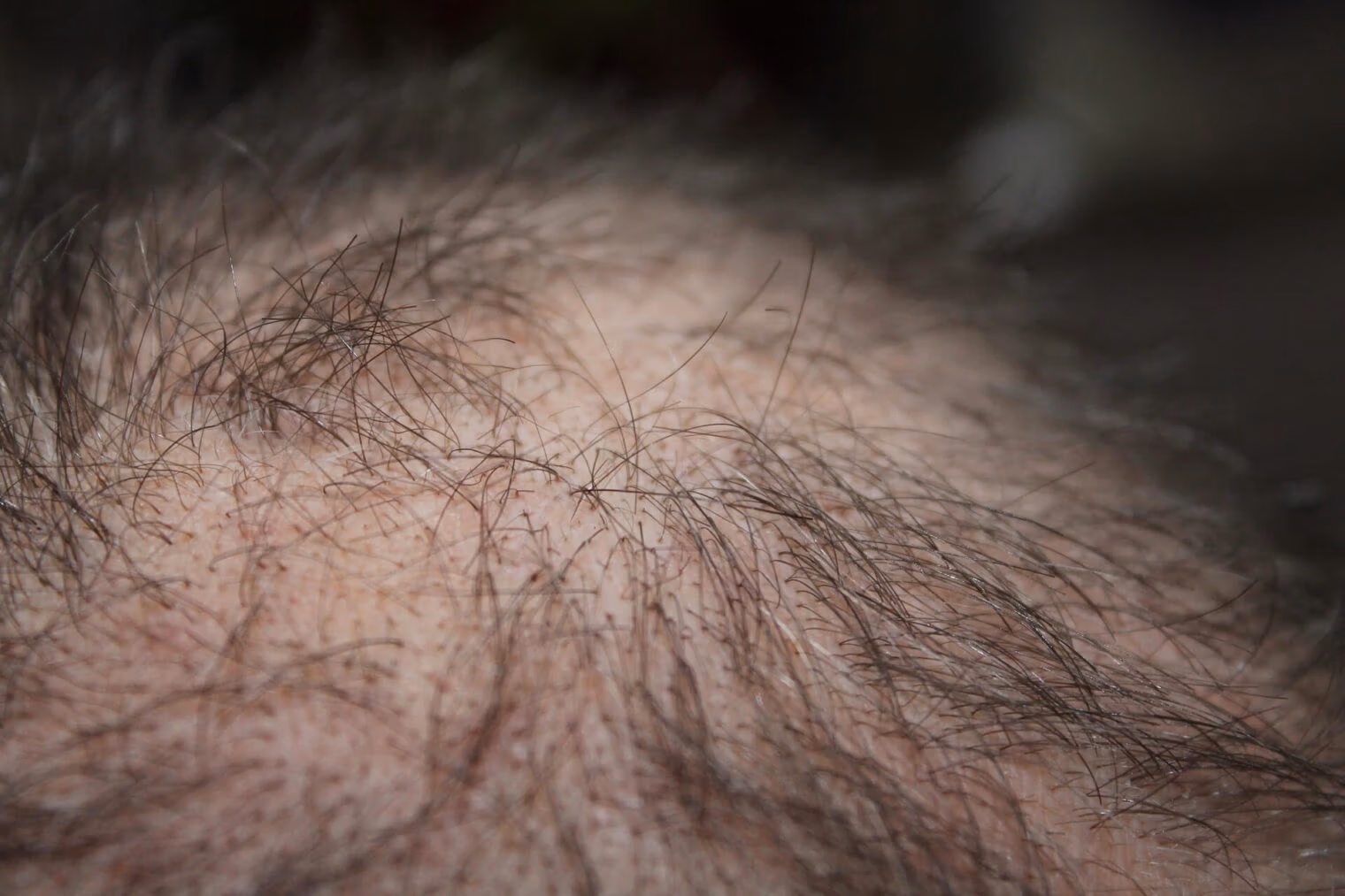 reduce male hair loss in Bangkok in 2024