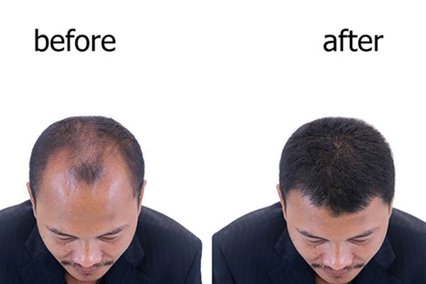 DHI hair transplant Bangkok, implanter pen technique at HE Clinic