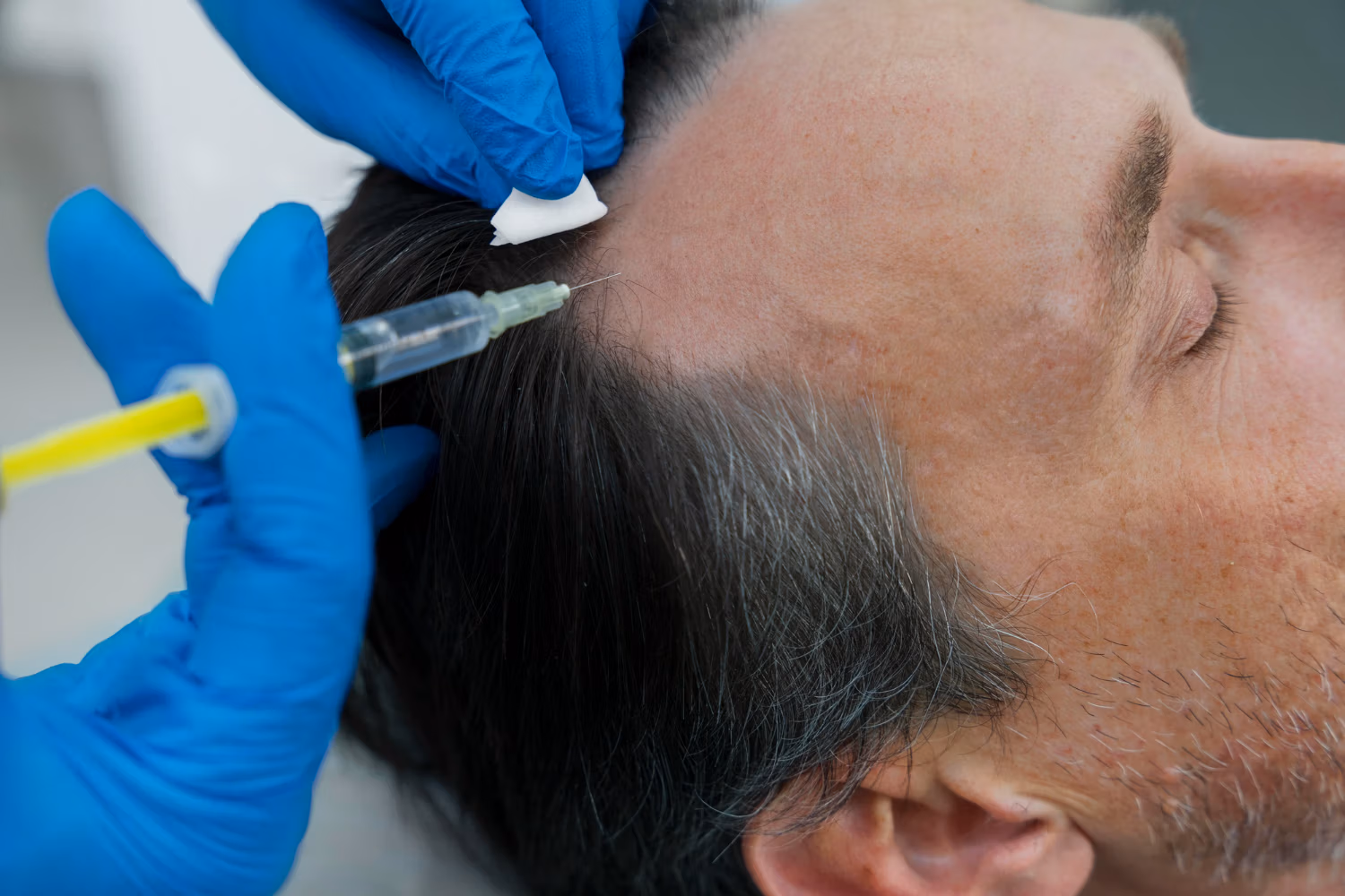 Scalp Micro Pigmentation Treatments in Bangkok 2024