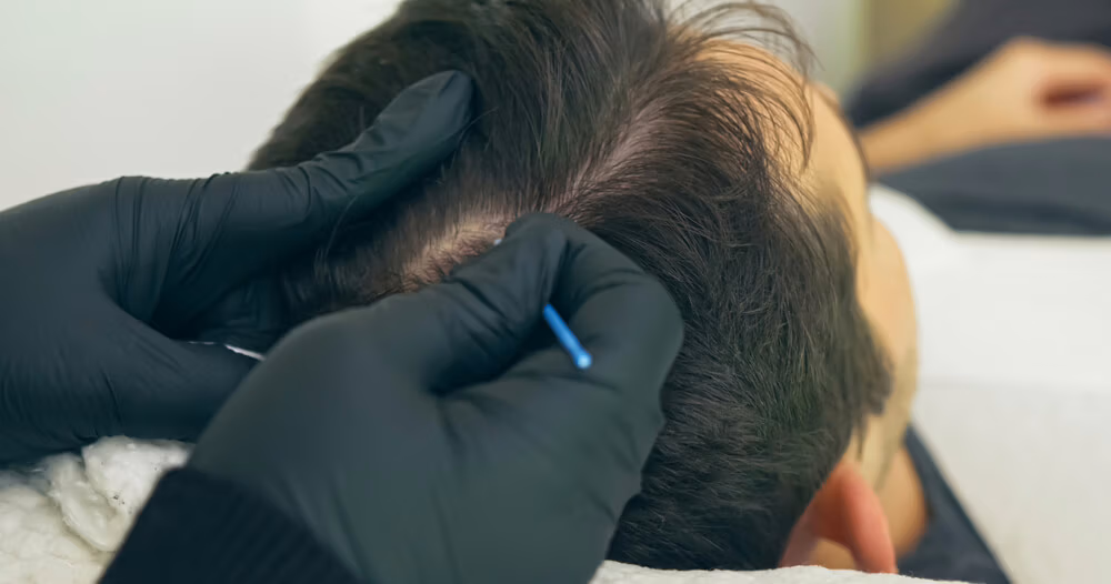 Scalp Micropigmentation In 2026 for men