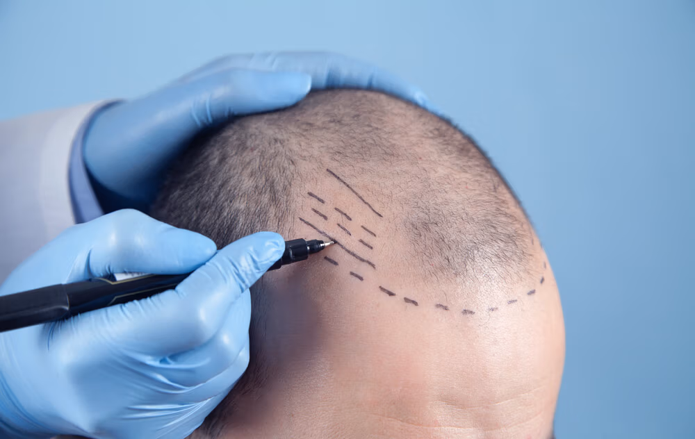 Platelet-Rich Plasma vs Hair Transplants in 2025