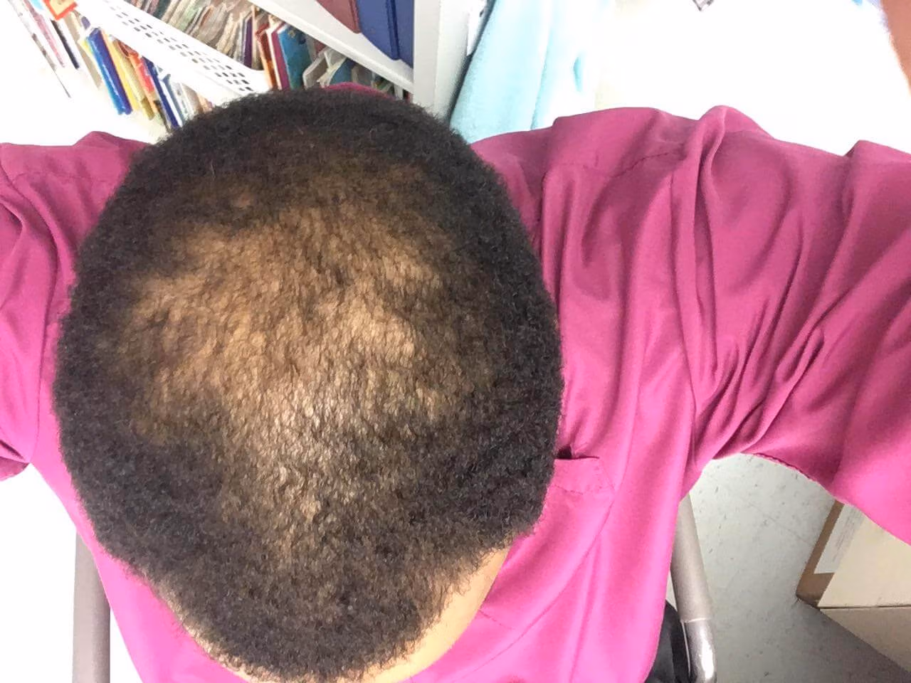 dealing with solutions for male hair loss